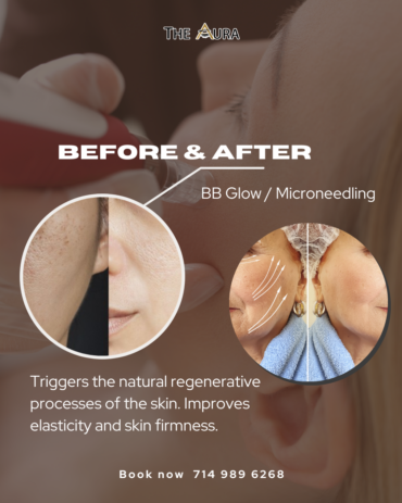 Discover natural beauty with BB Glow and Micro-needling with Aura Beauty in Orange County