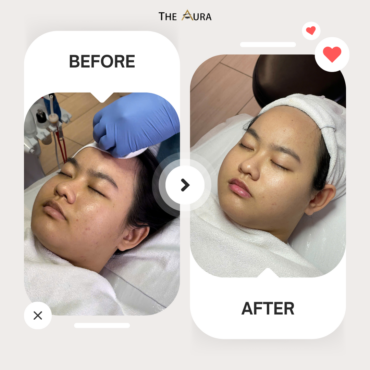 Before After BB Glow