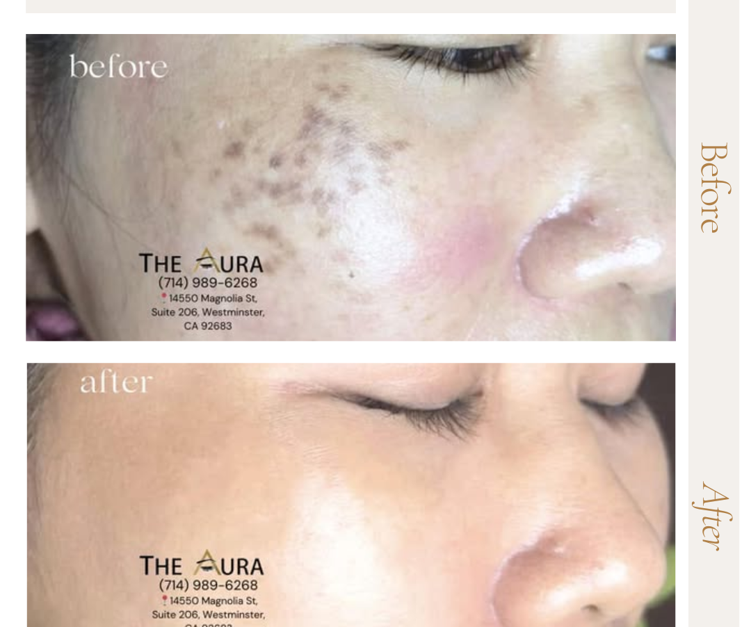 MELASMA - CAUSES, TREATMENTS AND SOLUTIONS AT THE AURA!