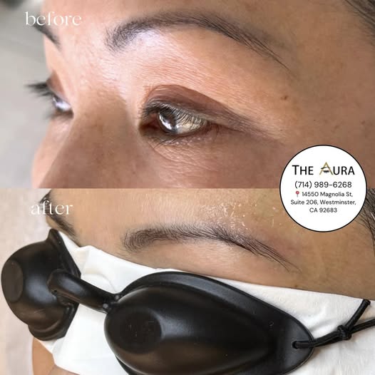 Is Eyebrow Tattoo Removal at The Aura Painful? Answering Customers' Biggest Concerns
