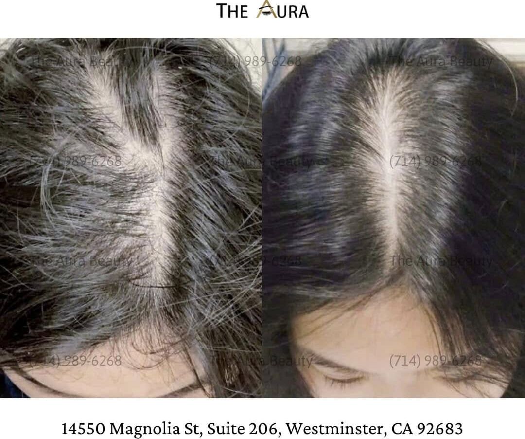 SOLUTION FOR BALDNESS – HAIR LOSS – STIMULATES FAST HAIR GROWTH