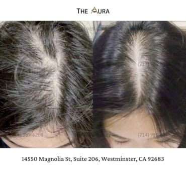 SOLUTION FOR BALDNESS – HAIR LOSS – STIMULATES FAST HAIR GROWTH