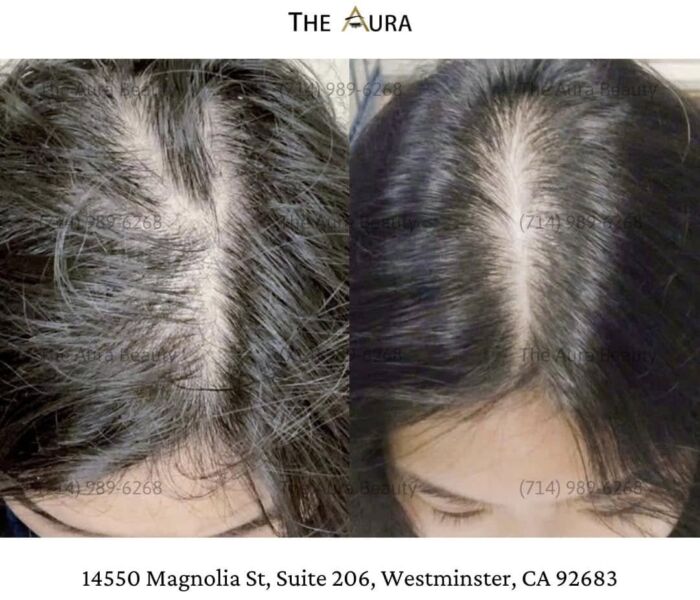 SOLUTION FOR BALDNESS – HAIR LOSS – STIMULATES FAST HAIR GROWTH