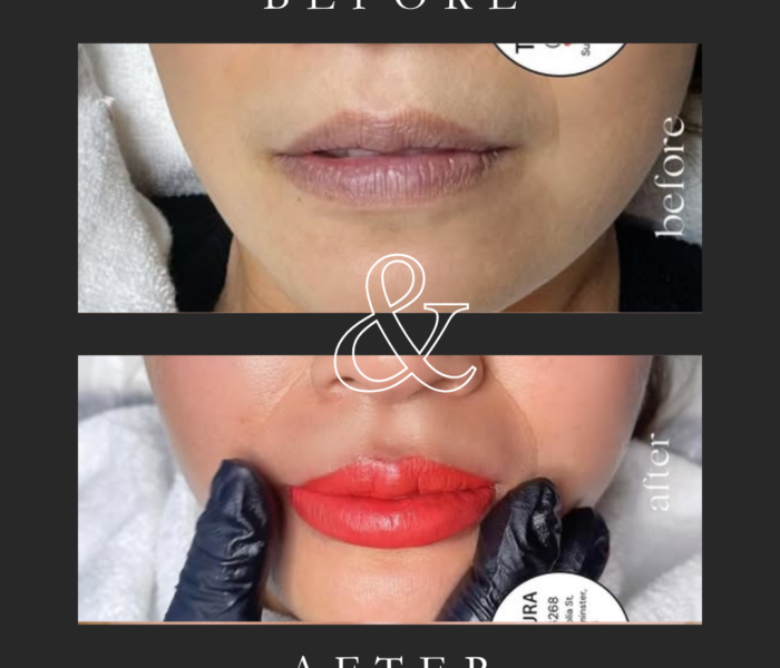 Lips Tattoo Before And After