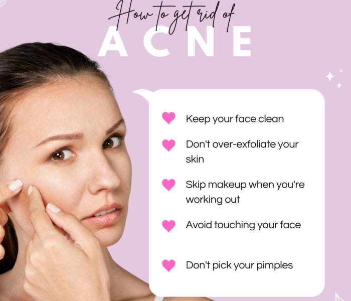 🌸How to get rid of acne🌸